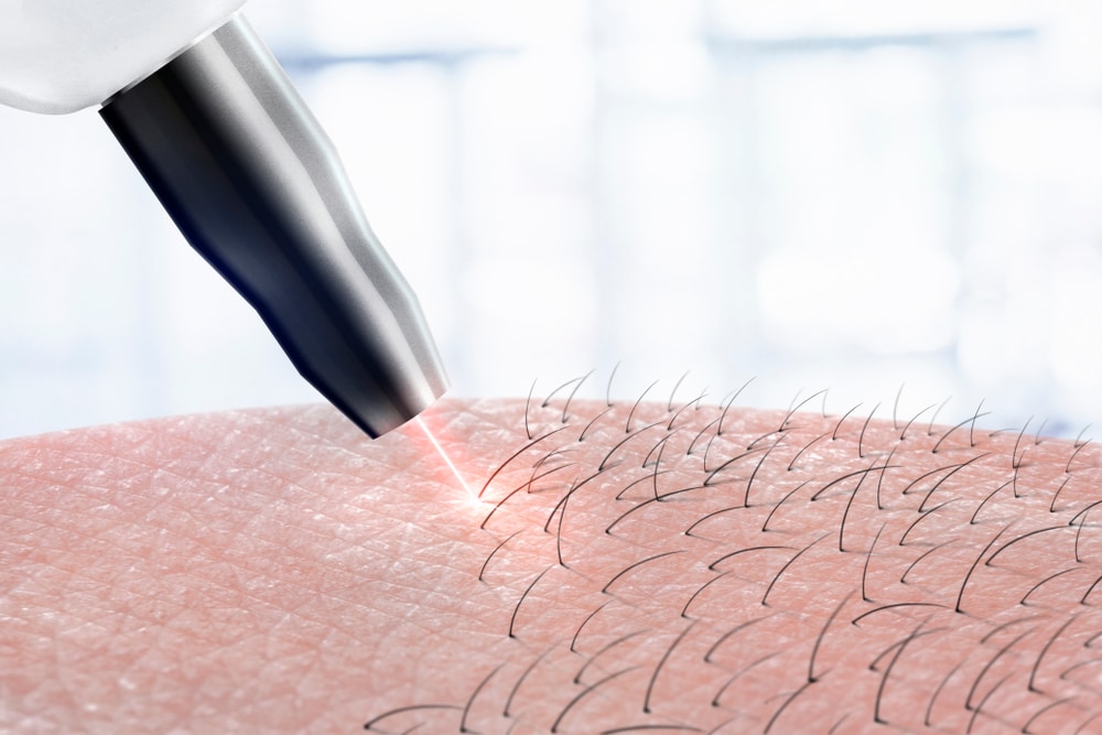 Image showing a laser emitting light toward hair follicles on the skin.