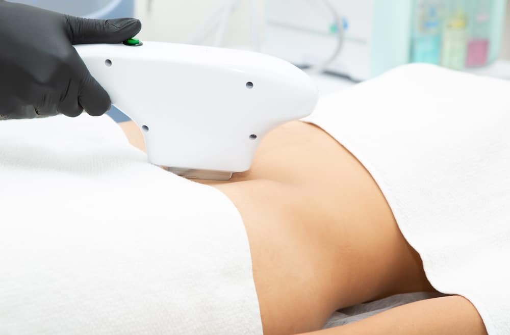 Woman laying on a table covered on her top and bottom with a medical sheet while someone performs laser hair removal on her bikini area.