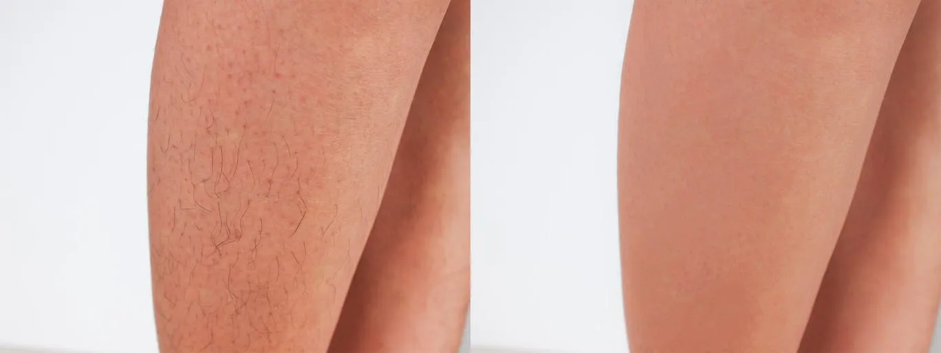 Image of before and after of leg hair being removed.