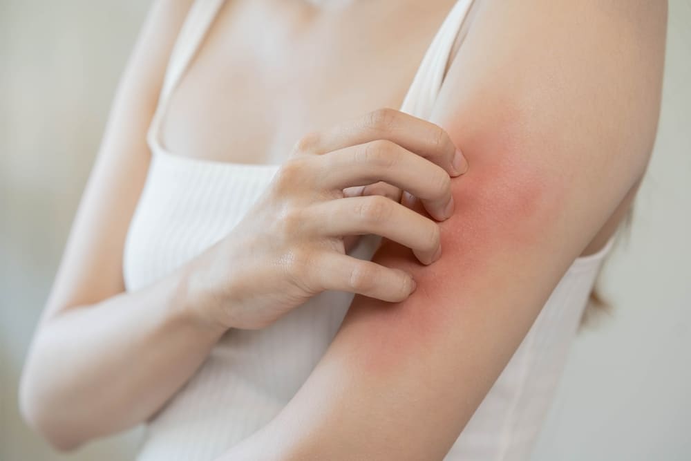 Closeup of woman’s arm with redness and her other hand scratching it.