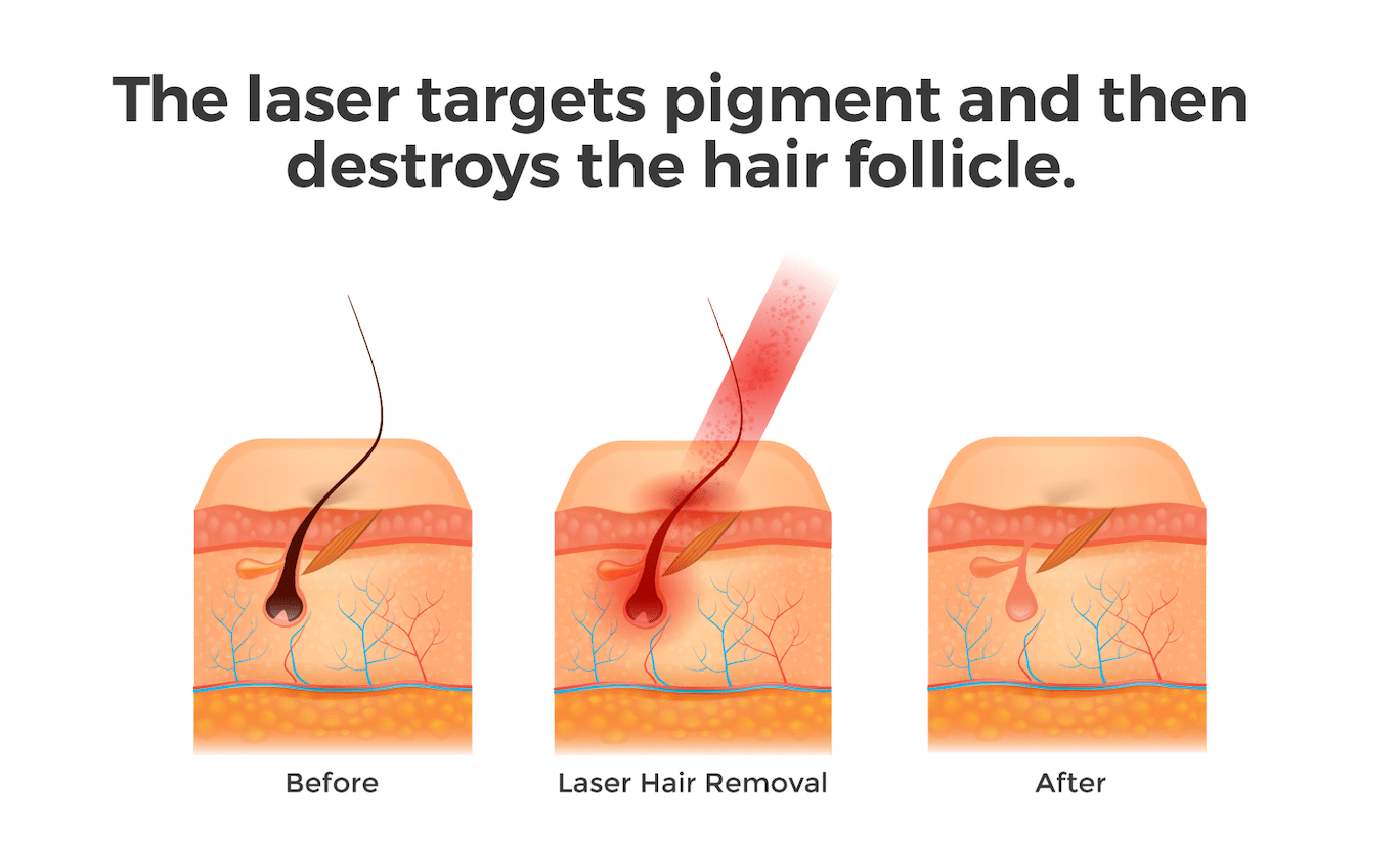 Does Laser Hair Removal Affect Tattoos? LivSmooth