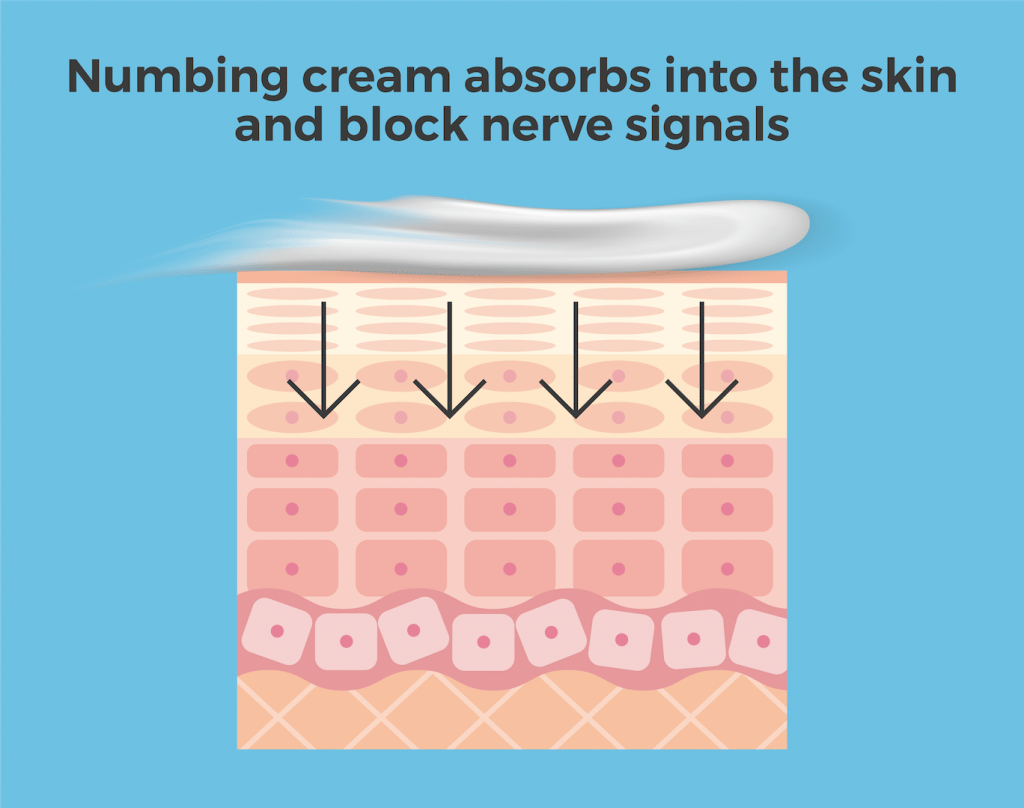 Graphic depicting numbing cream absorbing into the skin with text that reads, “Numbing cream absorbs into the skin and blocks nerve signals”.