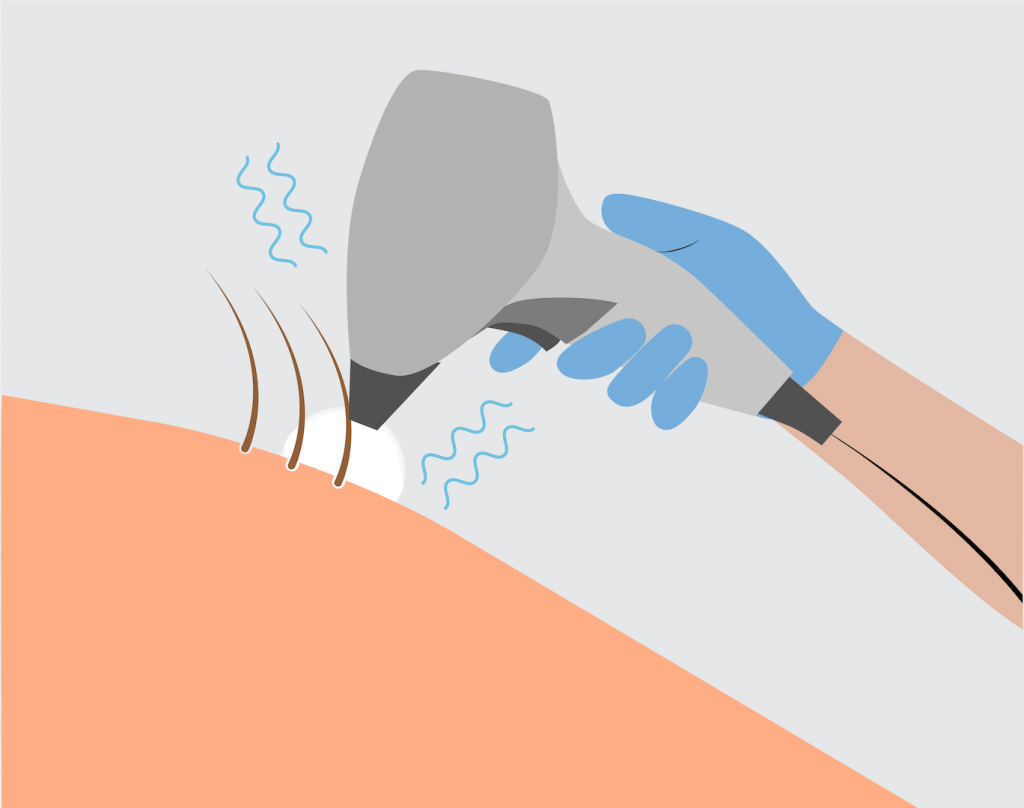 Graphic depicting a laser cooling the skin during hair removal.