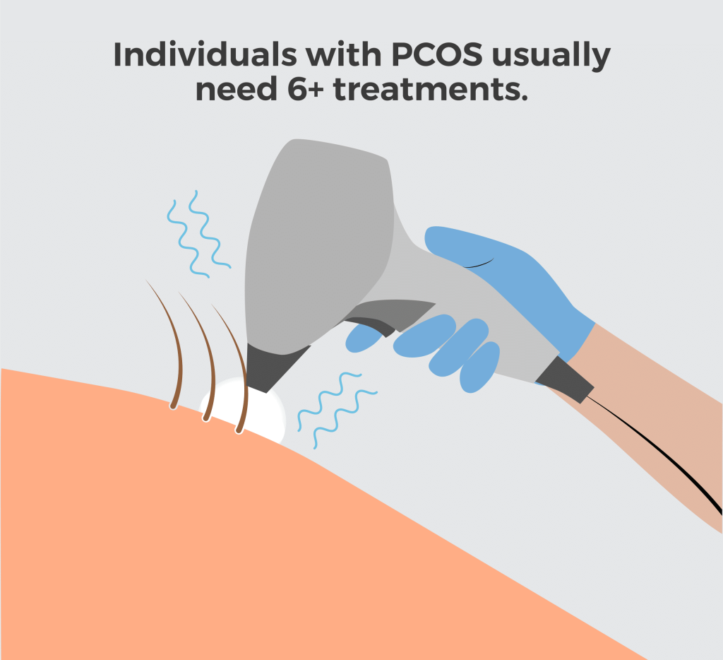 Illustration showing laser hair removal with text that reads, “Individuals with PCOS usually need 6+ treatments.”