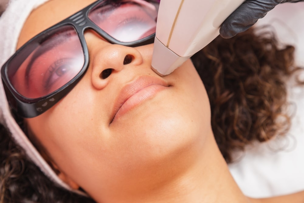 Close up of a Black woman receiving laser hair removal on her upper lip.